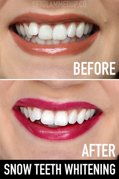 Unlock the Power of Snow Magic Powder for a Whiter, Brighter Smile